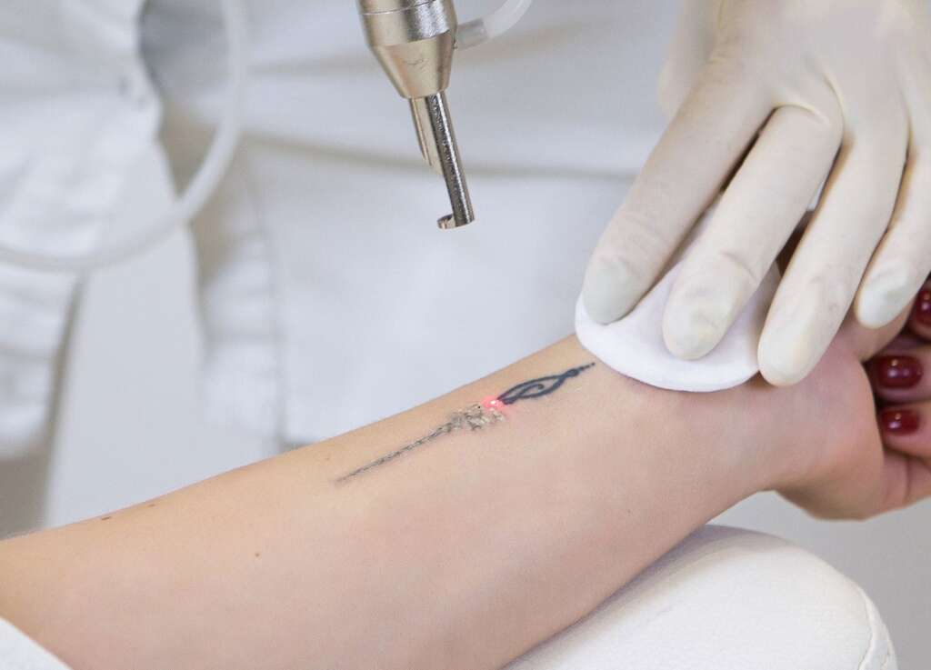 The Role of Skin Tone in Tattoo Removal Effectiveness