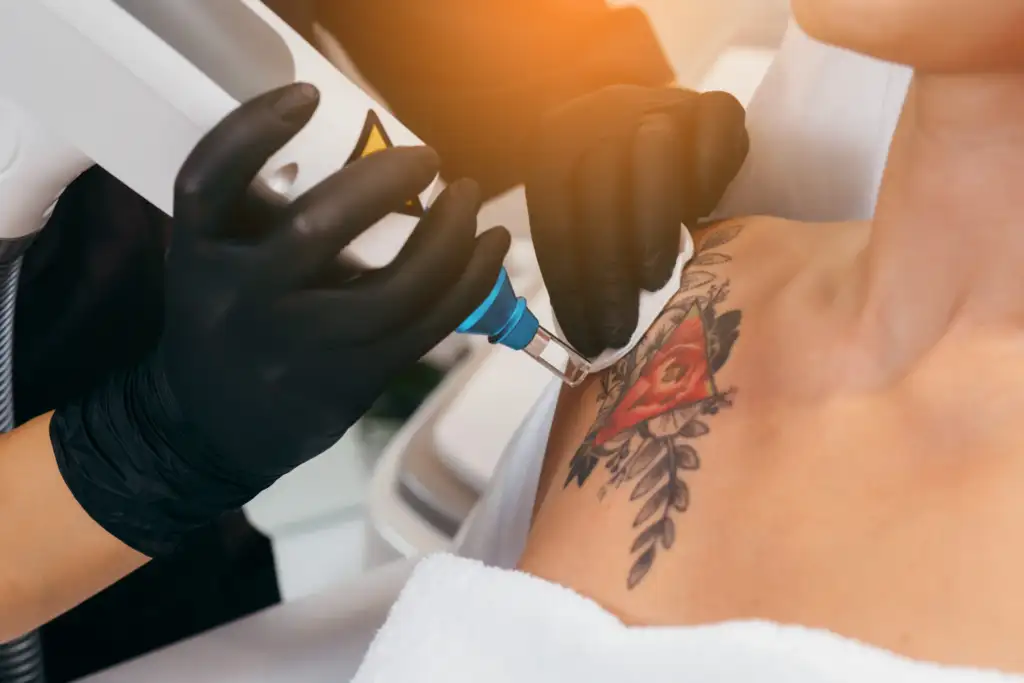 The Role of Skin Tone in Tattoo Removal Effectiveness