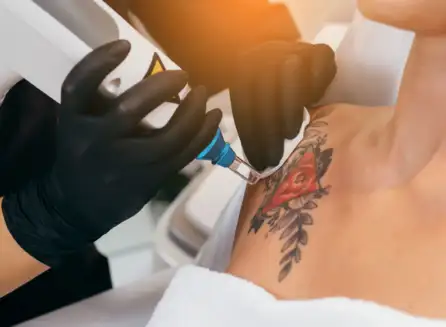 The Role of Skin Tone in Tattoo Removal Effectiveness