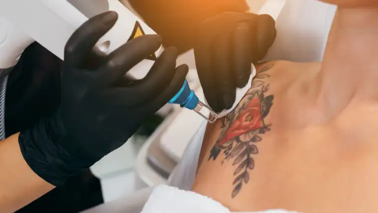 The Role of Skin Tone in Tattoo Removal Effectiveness