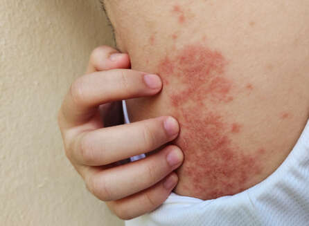 Understanding Dupixent Side Effects and Legal Options