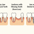 Recognizing the Signs You May Need Dental Implants Soon